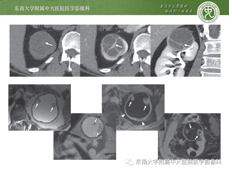 【病例】黄色肉芽肿性肾盂肾炎1例CT影像
