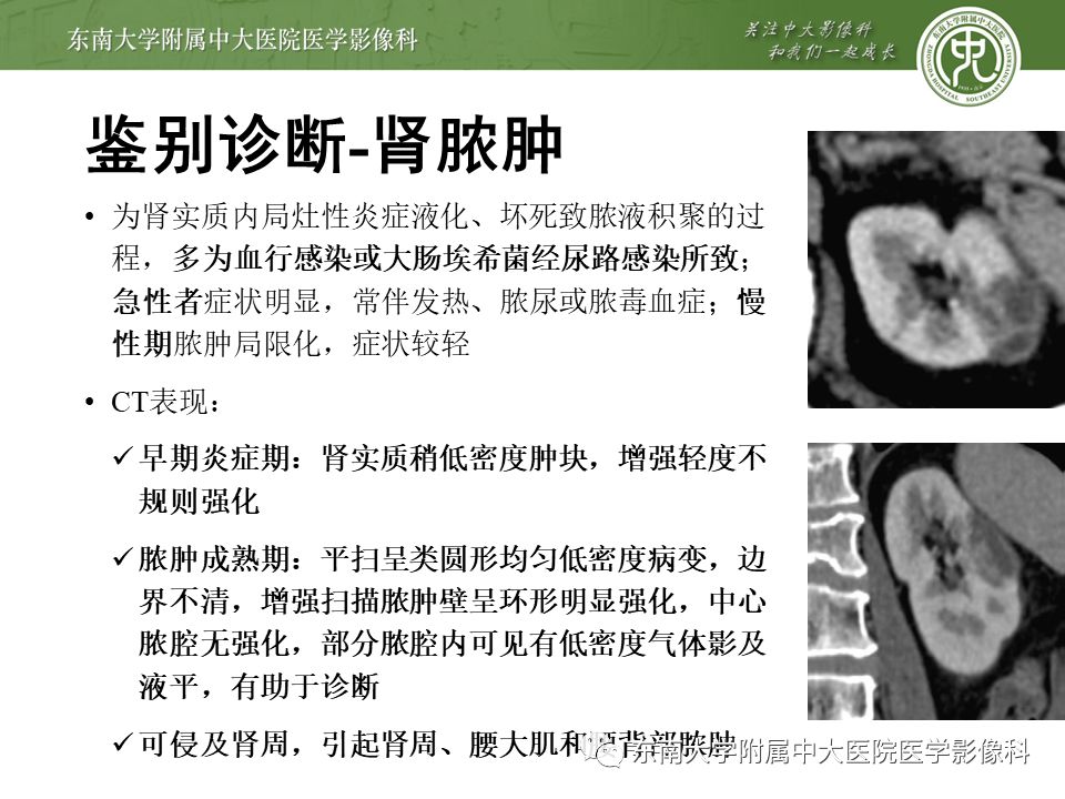 【病例】黄色肉芽肿性肾盂肾炎1例CT影像