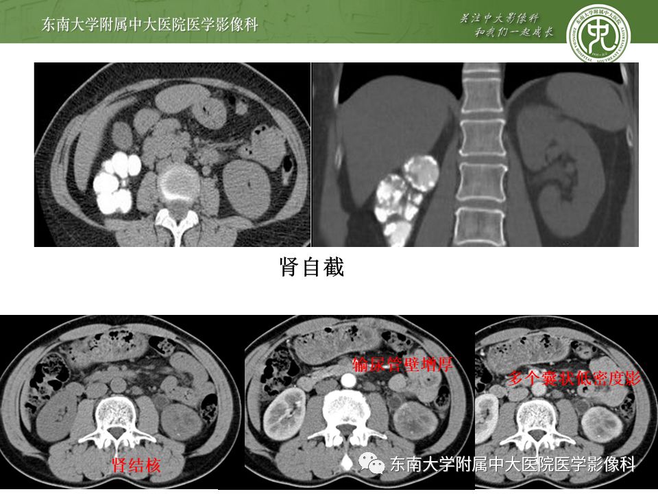 【病例】黄色肉芽肿性肾盂肾炎1例CT影像