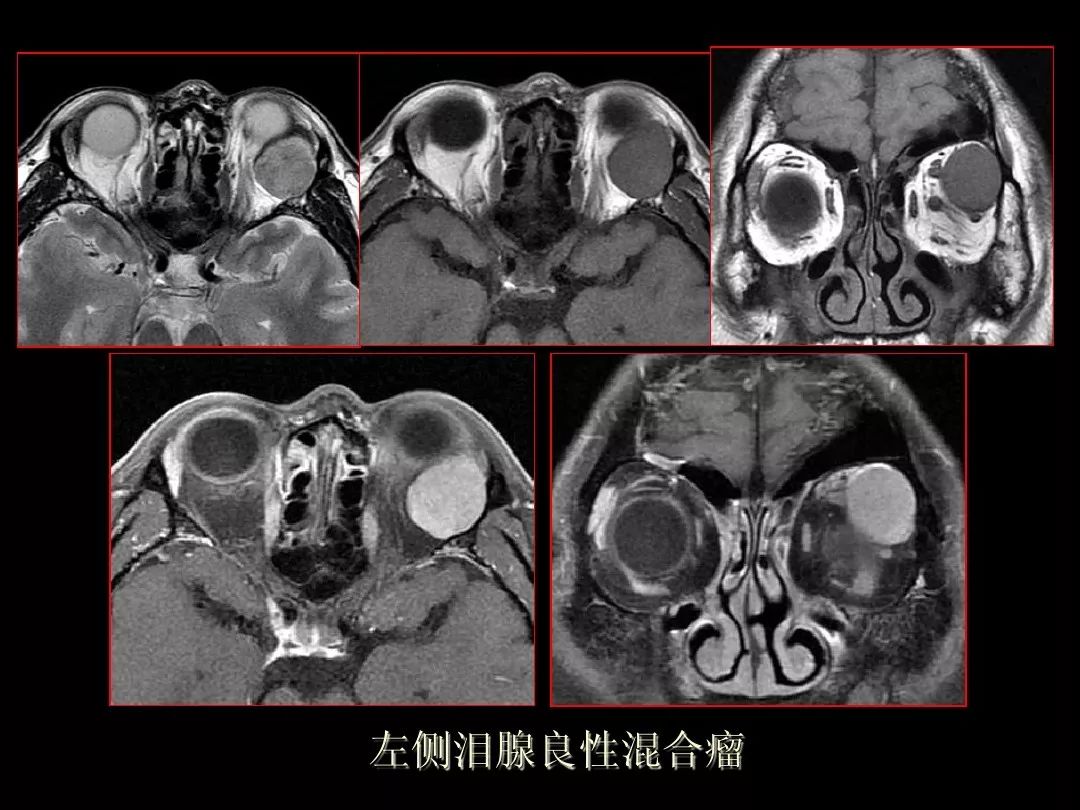 【PPT】泪腺肿瘤及肿瘤样病变的影像学诊断