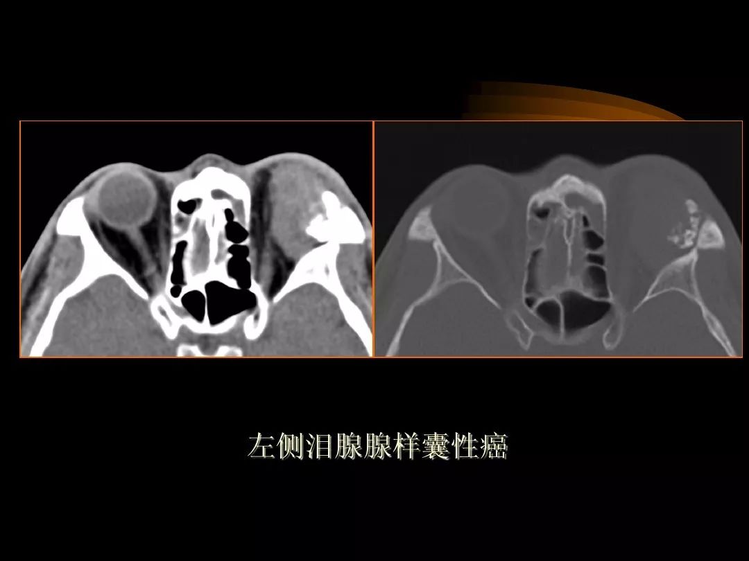 【PPT】泪腺肿瘤及肿瘤样病变的影像学诊断