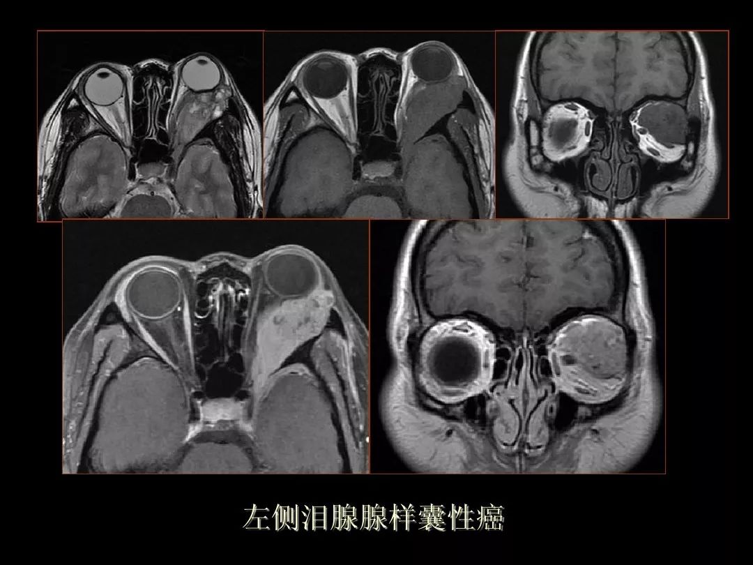 【PPT】泪腺肿瘤及肿瘤样病变的影像学诊断