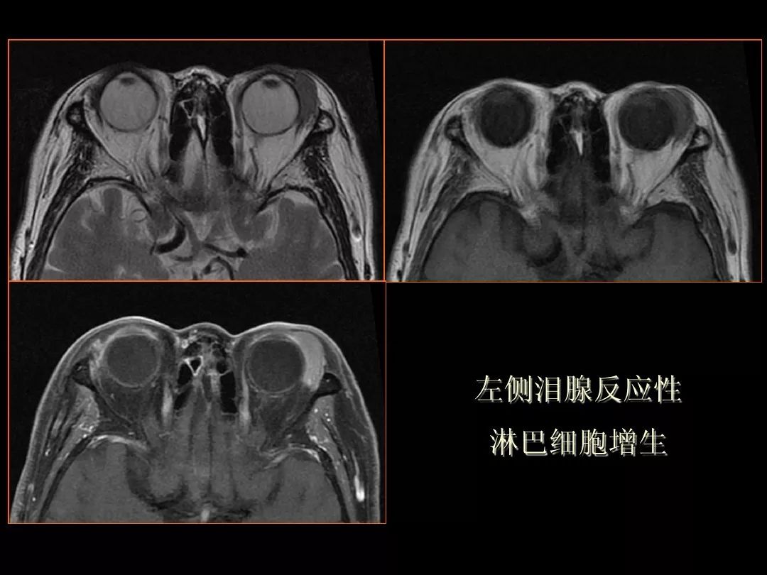 【PPT】泪腺肿瘤及肿瘤样病变的影像学诊断