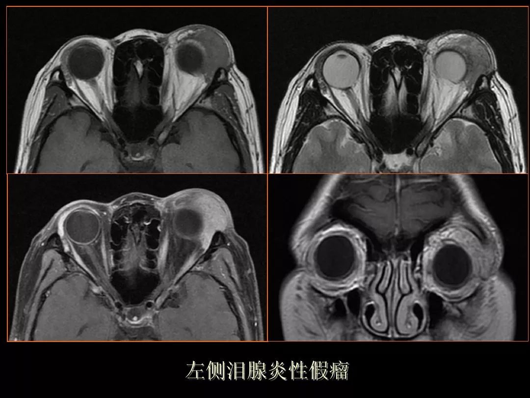 【PPT】泪腺肿瘤及肿瘤样病变的影像学诊断