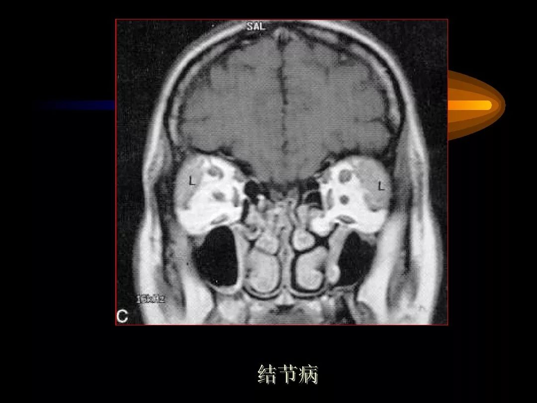 【PPT】泪腺肿瘤及肿瘤样病变的影像学诊断