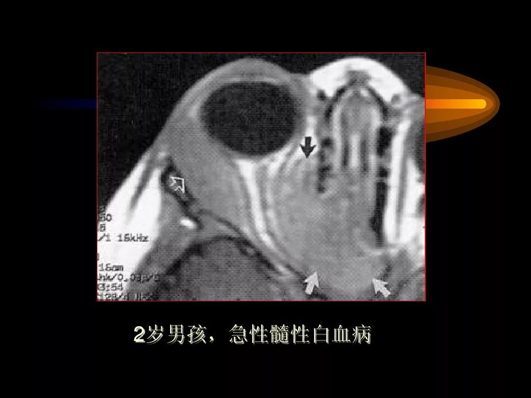 【PPT】泪腺肿瘤及肿瘤样病变的影像学诊断