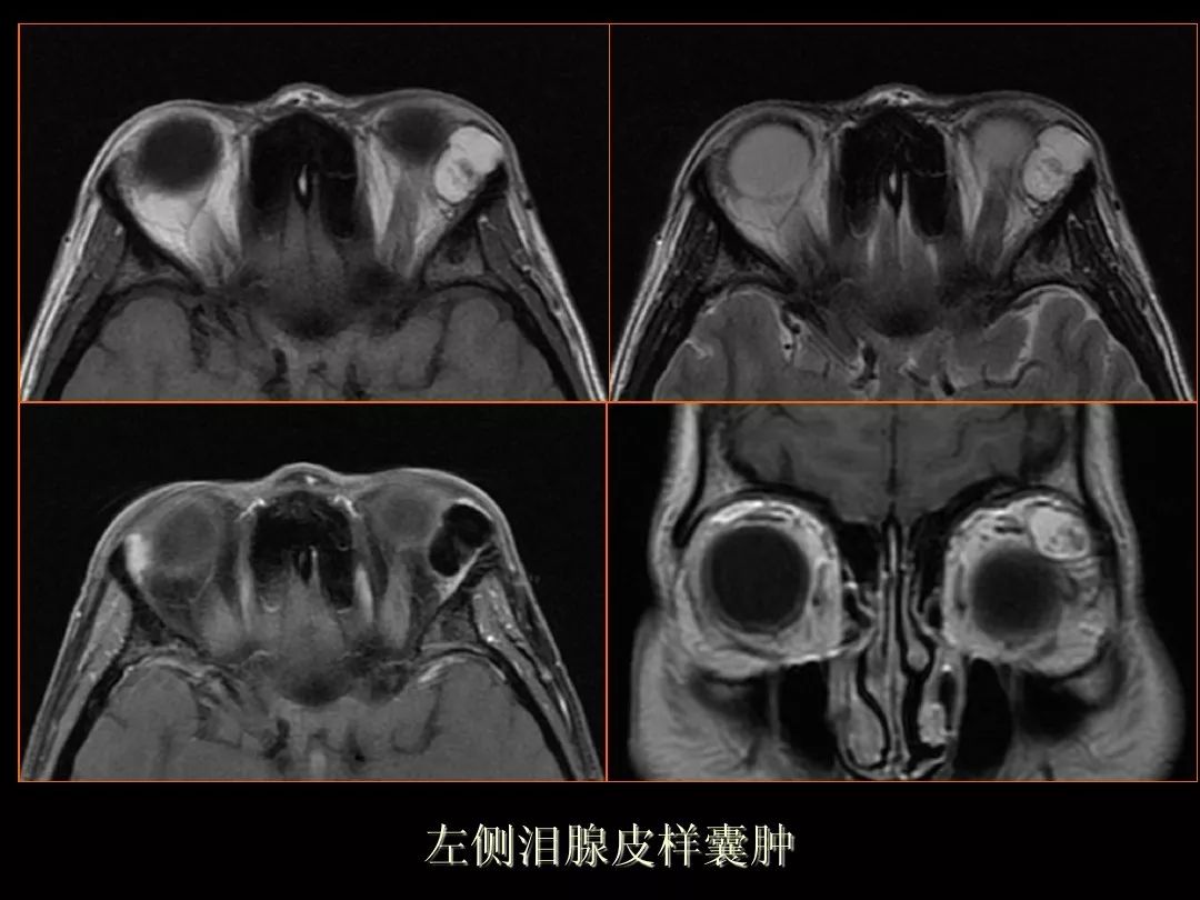 【PPT】泪腺肿瘤及肿瘤样病变的影像学诊断