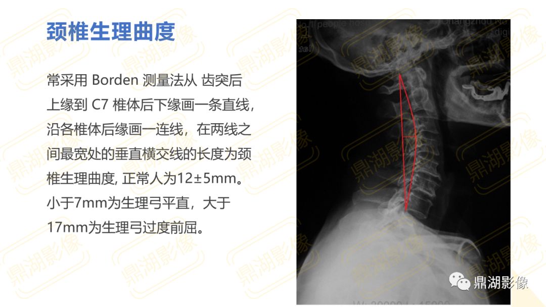 【PPT】脊柱X线测量