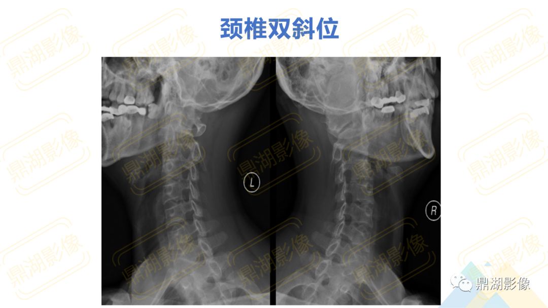 【PPT】脊柱X线测量
