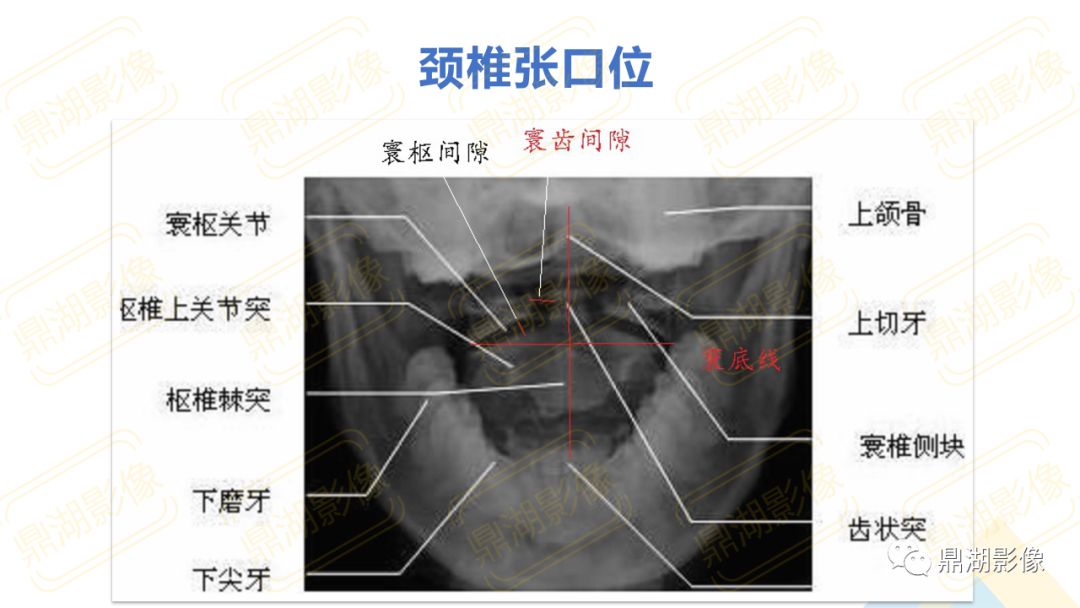 【PPT】脊柱X线测量