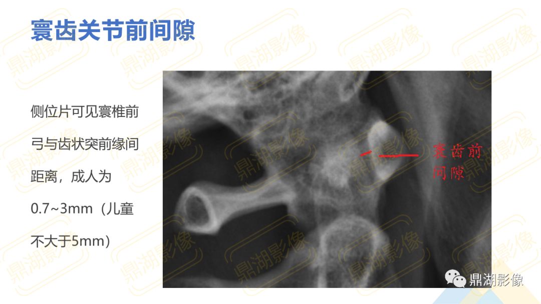 【PPT】脊柱X线测量