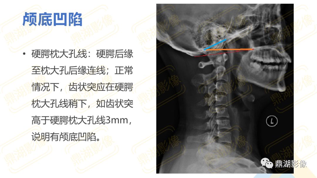 【PPT】脊柱X线测量