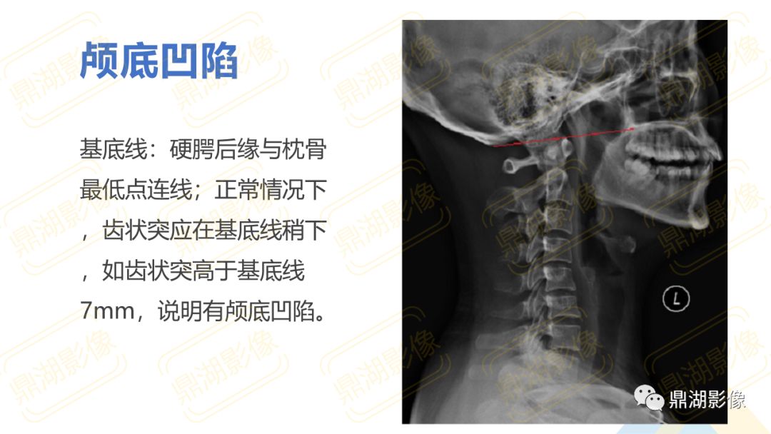 【PPT】脊柱X线测量