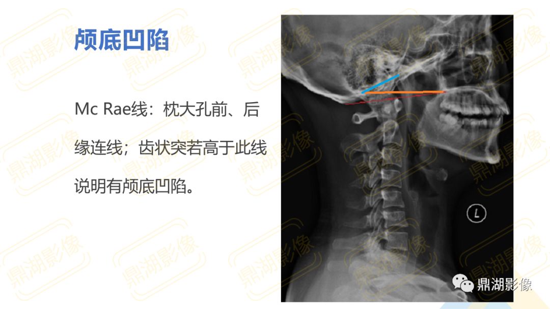 【PPT】脊柱X线测量