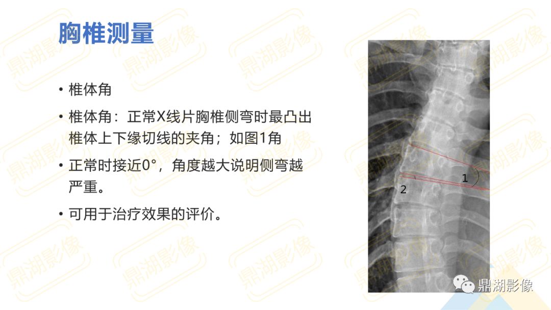 【PPT】脊柱X线测量