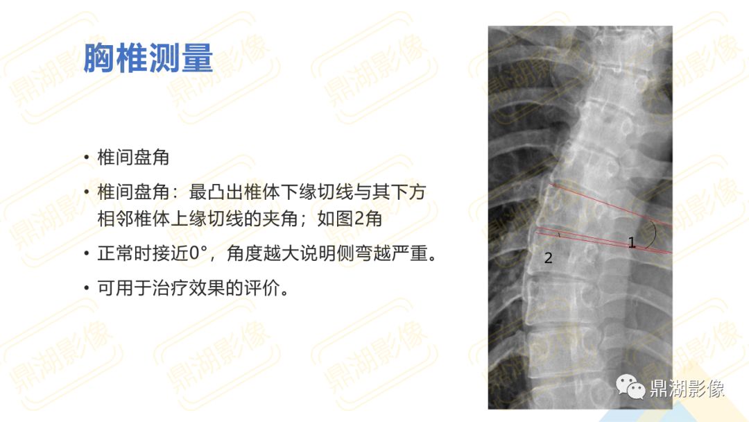 【PPT】脊柱X线测量