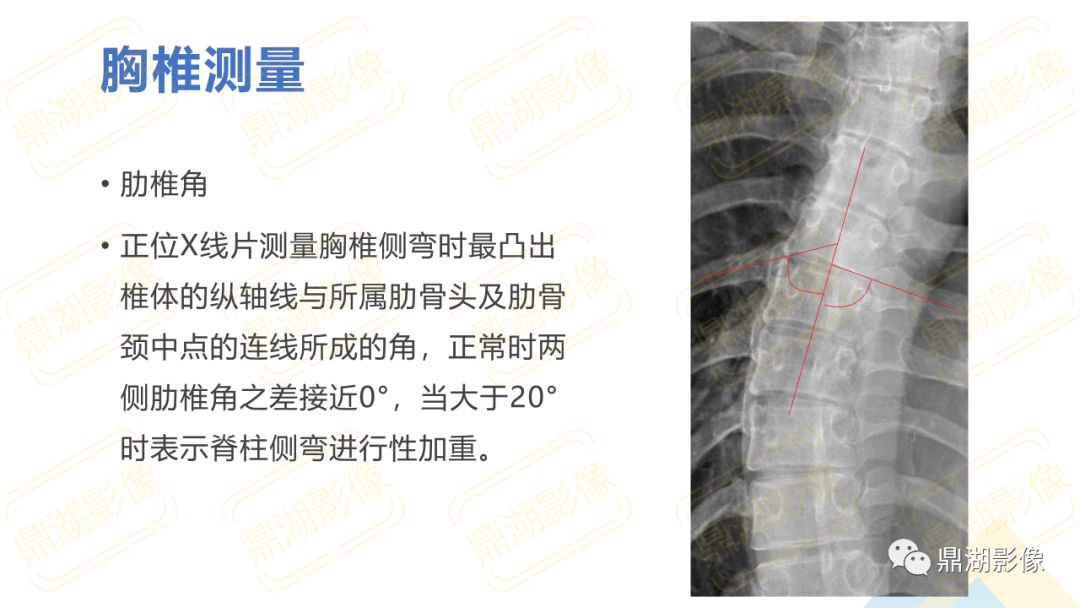 【PPT】脊柱X线测量