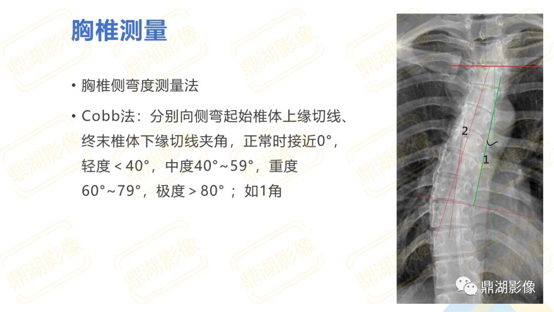 【PPT】脊柱X线测量