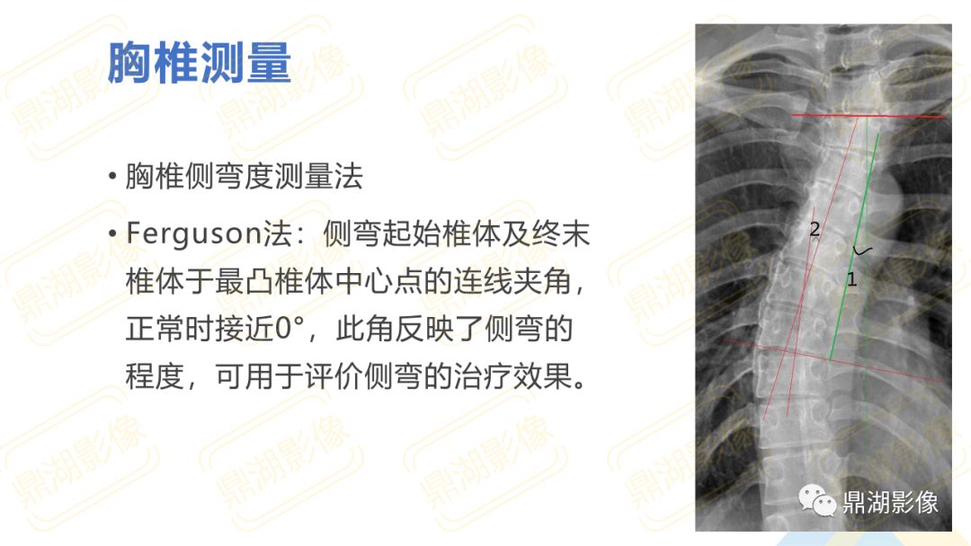 【PPT】脊柱X线测量
