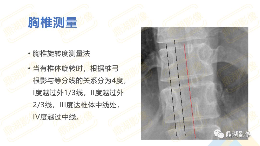【PPT】脊柱X线测量