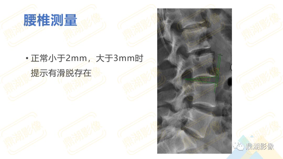 【PPT】脊柱X线测量