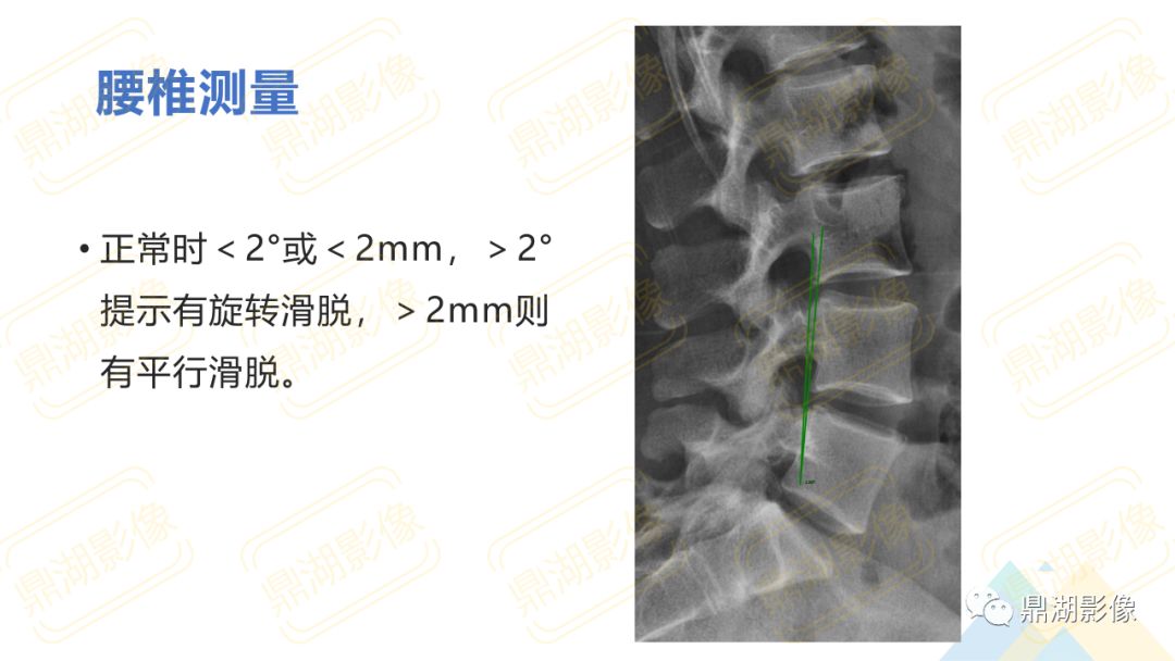 【PPT】脊柱X线测量
