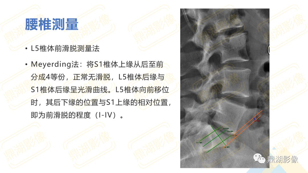 【PPT】脊柱X线测量