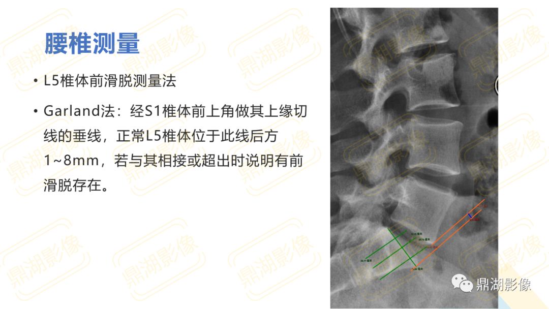 【PPT】脊柱X线测量