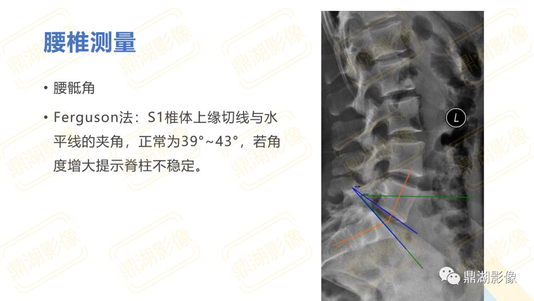 【PPT】脊柱X线测量