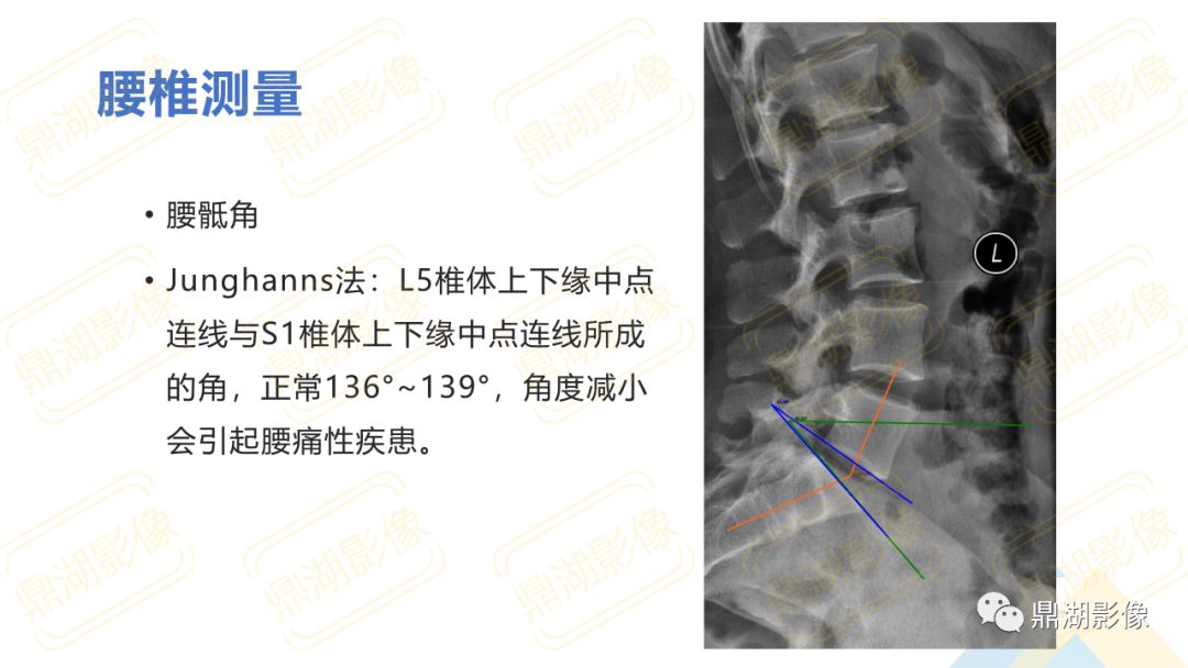 【PPT】脊柱X线测量