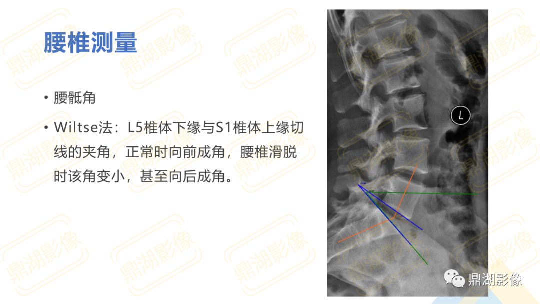 【PPT】脊柱X线测量