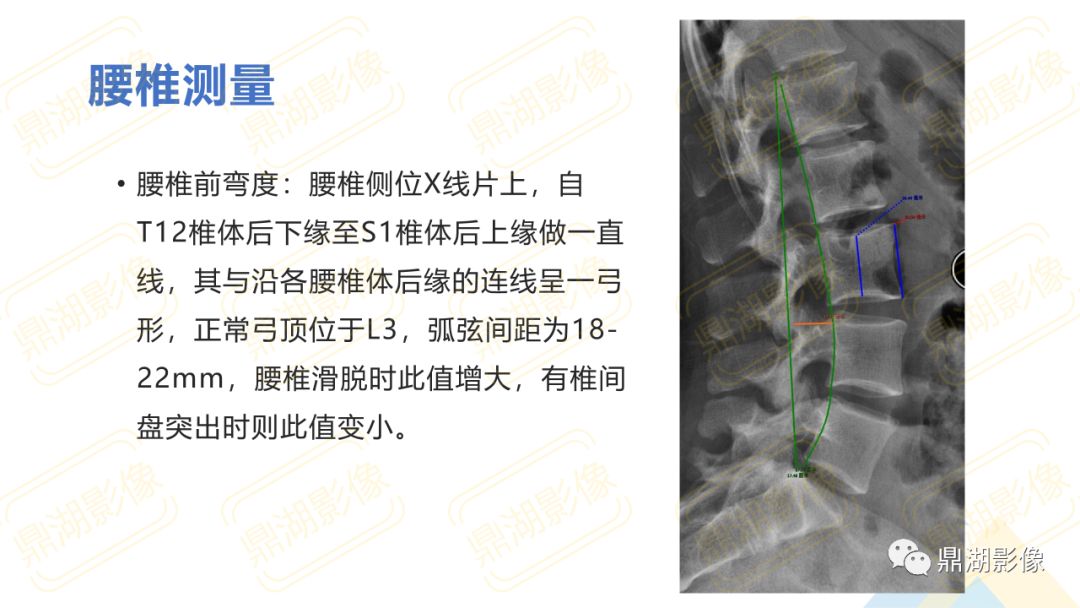 【PPT】脊柱X线测量