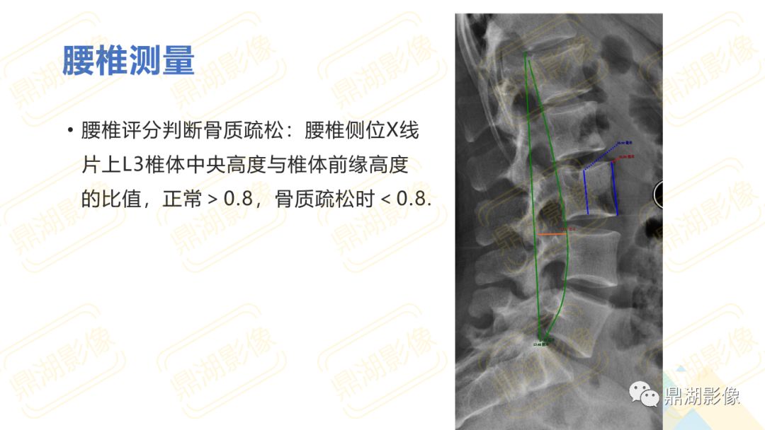 【PPT】脊柱X线测量