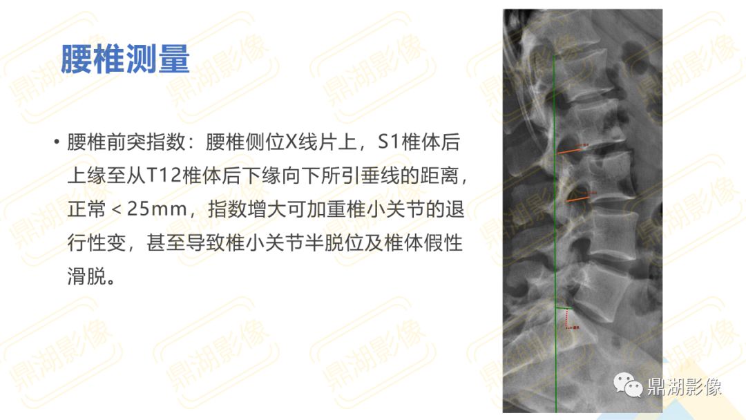 【PPT】脊柱X线测量