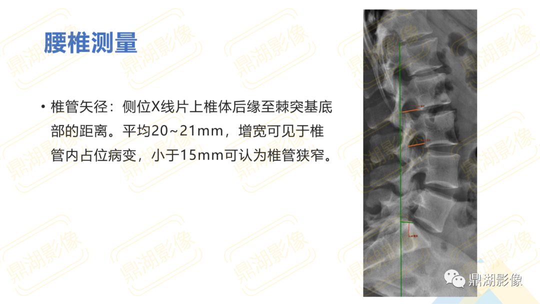 【PPT】脊柱X线测量