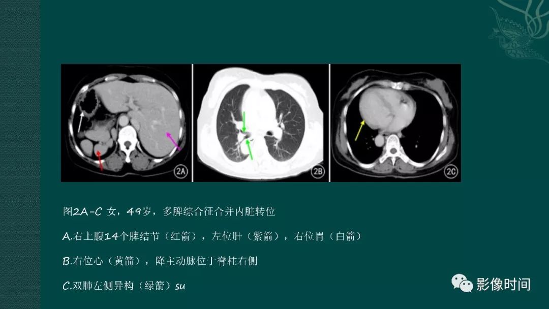 【PPT】多脾综合征