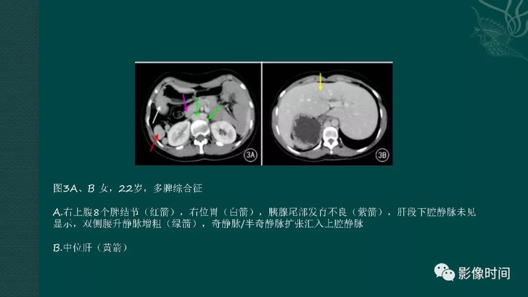 【PPT】多脾综合征