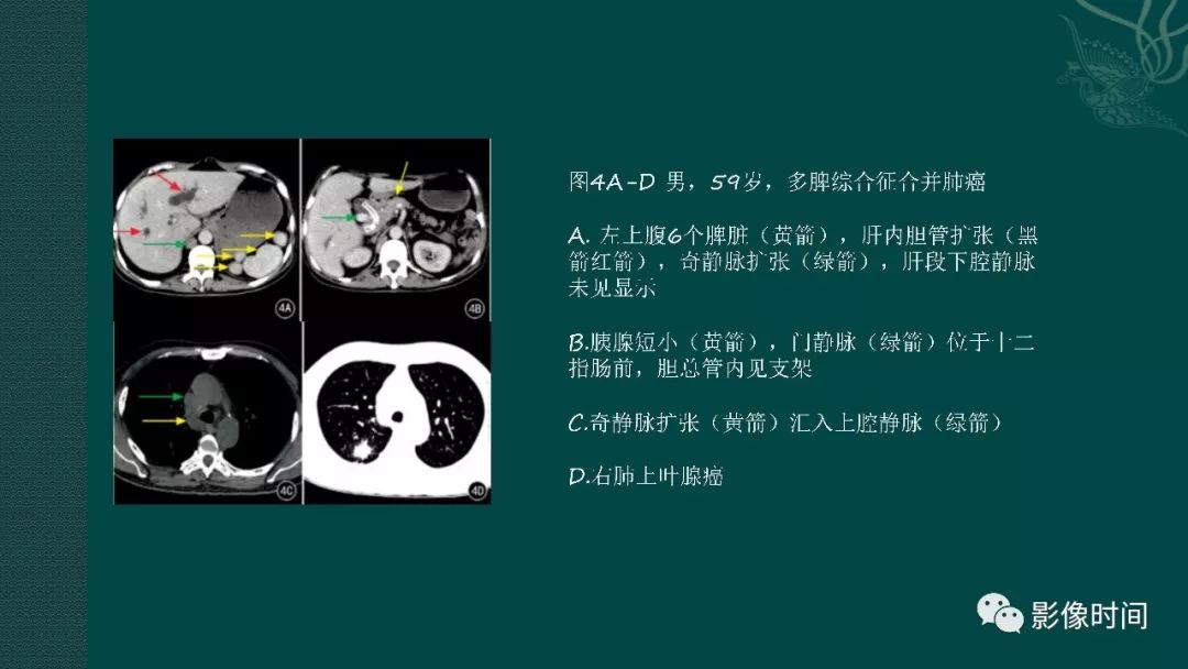 【PPT】多脾综合征