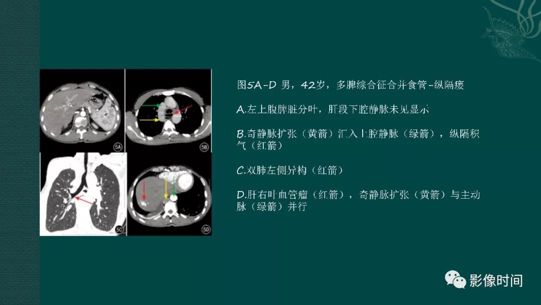 【PPT】多脾综合征