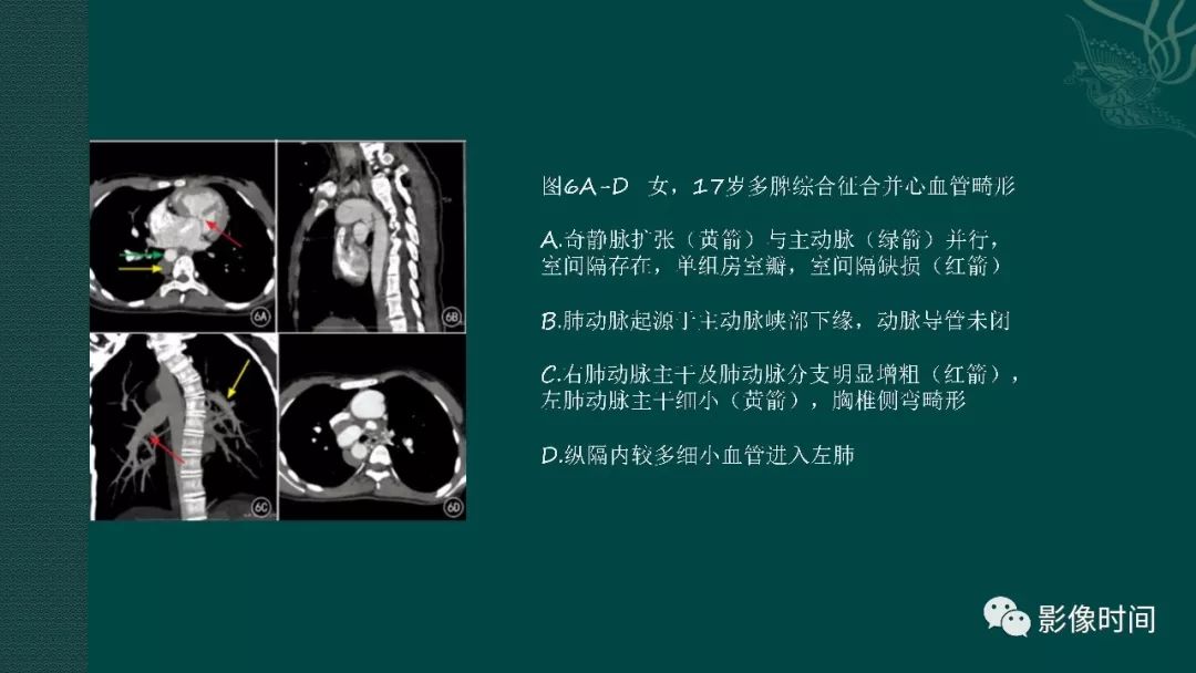 【PPT】多脾综合征
