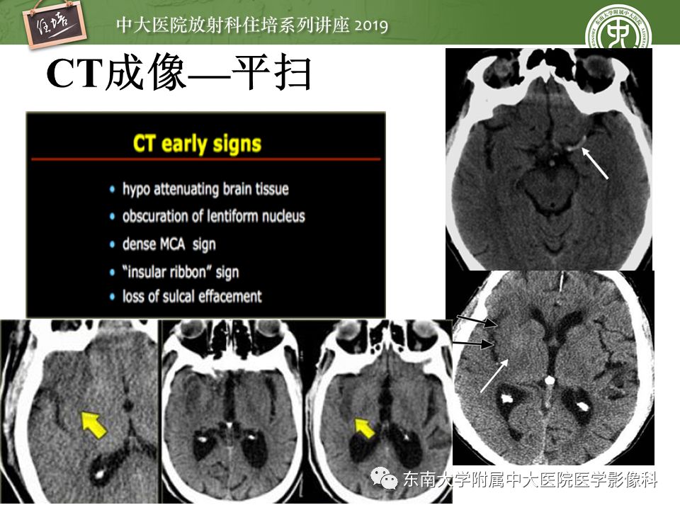 【PPT】急性缺血性脑卒中的影像评估