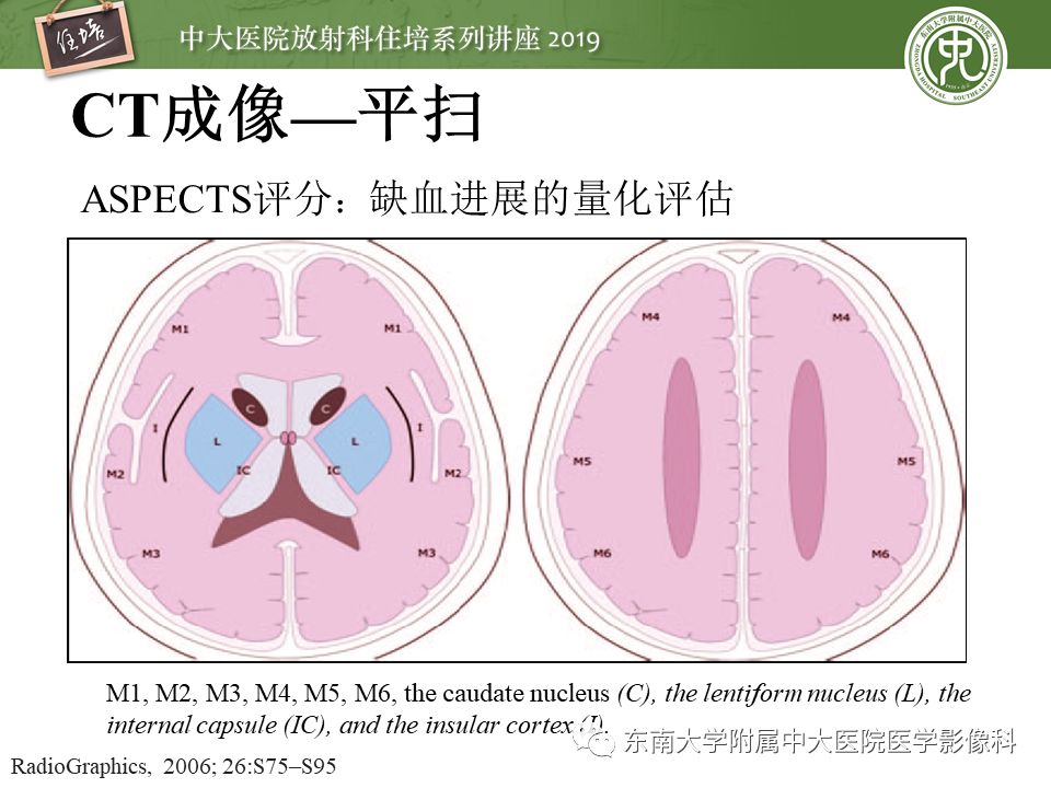 【PPT】急性缺血性脑卒中的影像评估