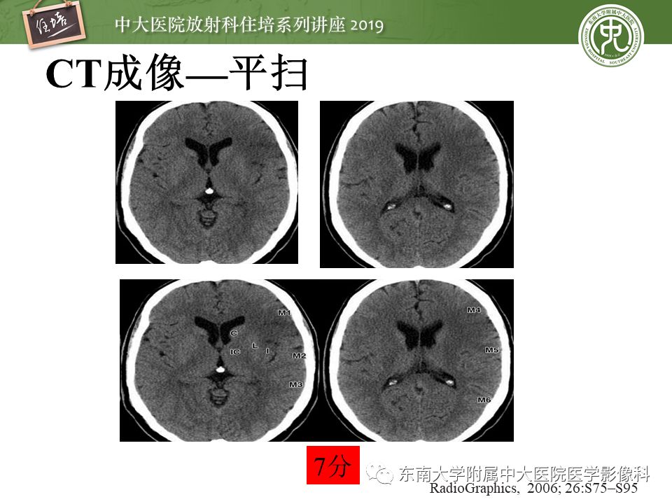 【PPT】急性缺血性脑卒中的影像评估