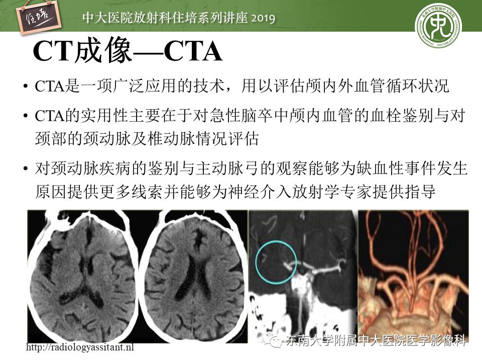 【PPT】急性缺血性脑卒中的影像评估