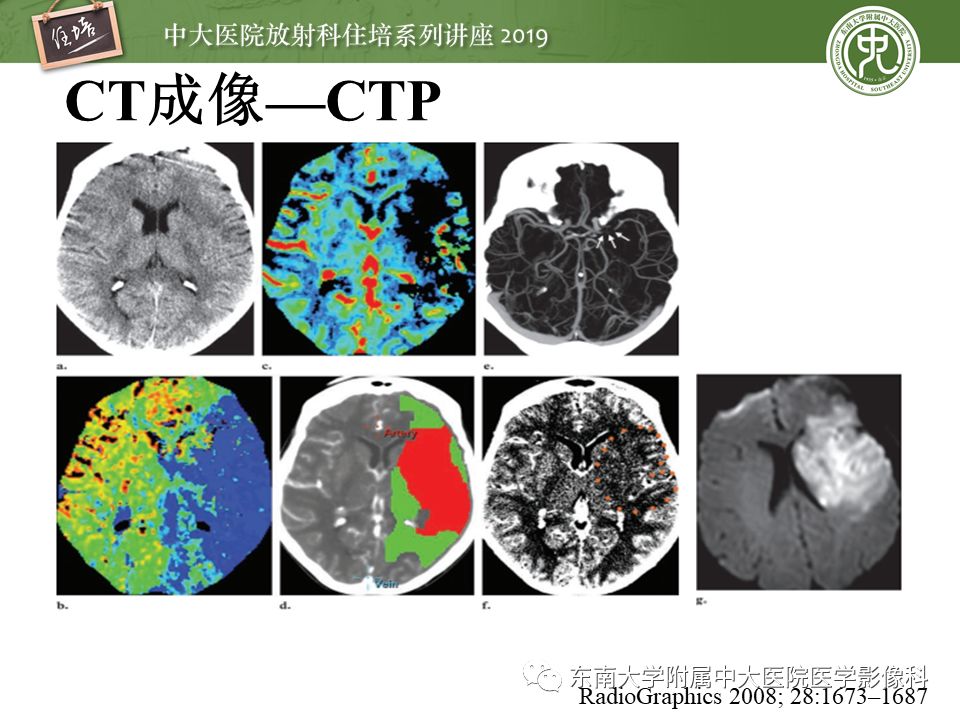 【PPT】急性缺血性脑卒中的影像评估