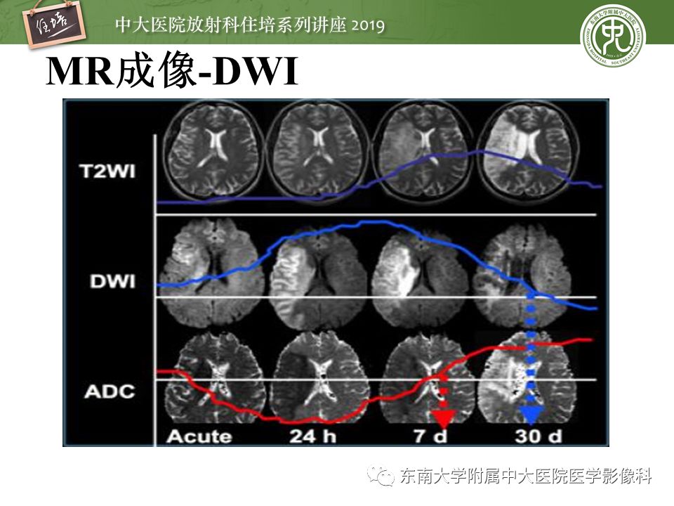 【PPT】急性缺血性脑卒中的影像评估