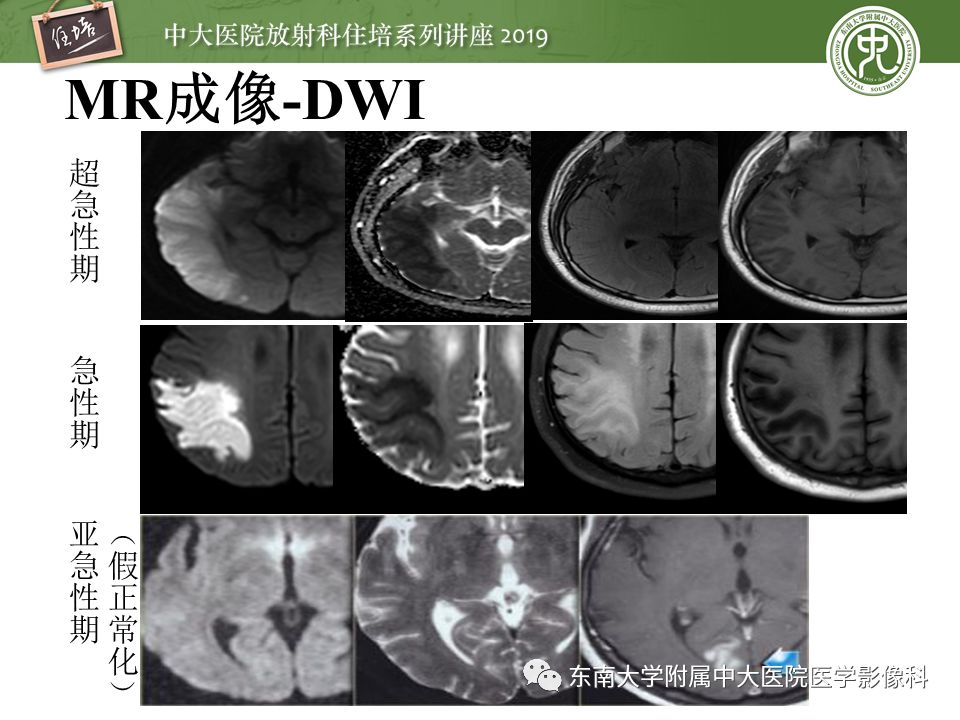 【PPT】急性缺血性脑卒中的影像评估