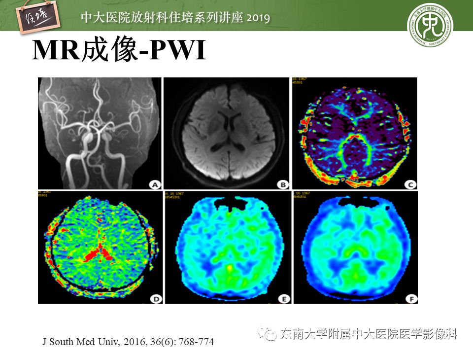 【PPT】急性缺血性脑卒中的影像评估