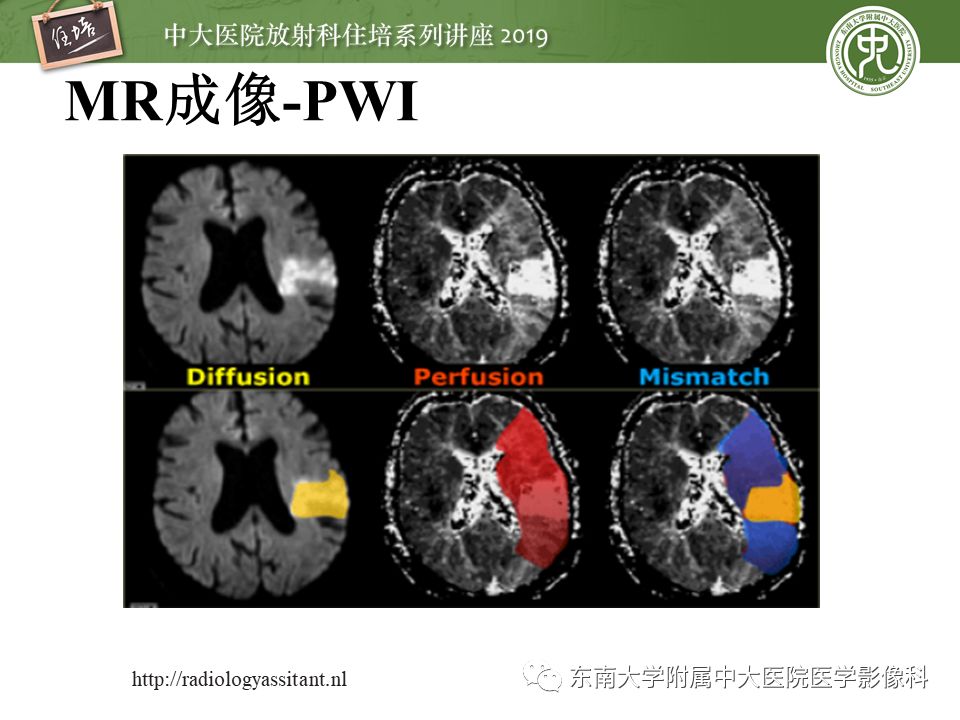 【PPT】急性缺血性脑卒中的影像评估