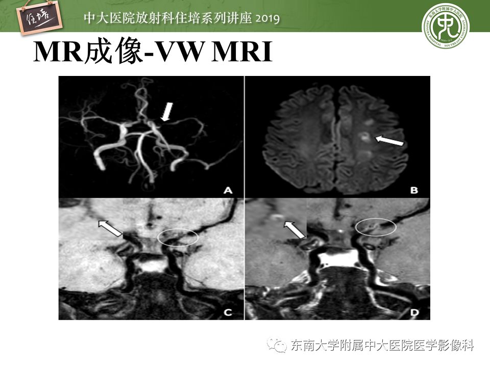 【PPT】急性缺血性脑卒中的影像评估